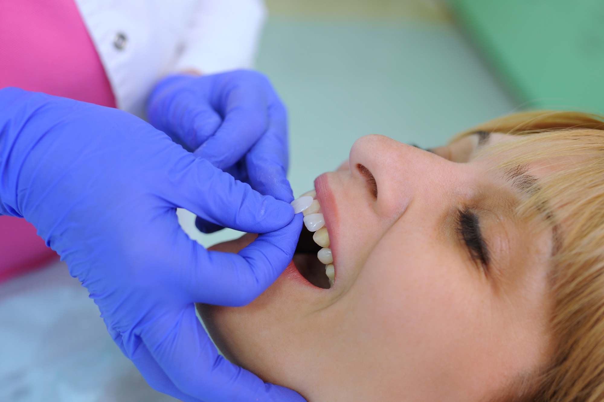 How Long Does It Take To Have Dental Veneers?