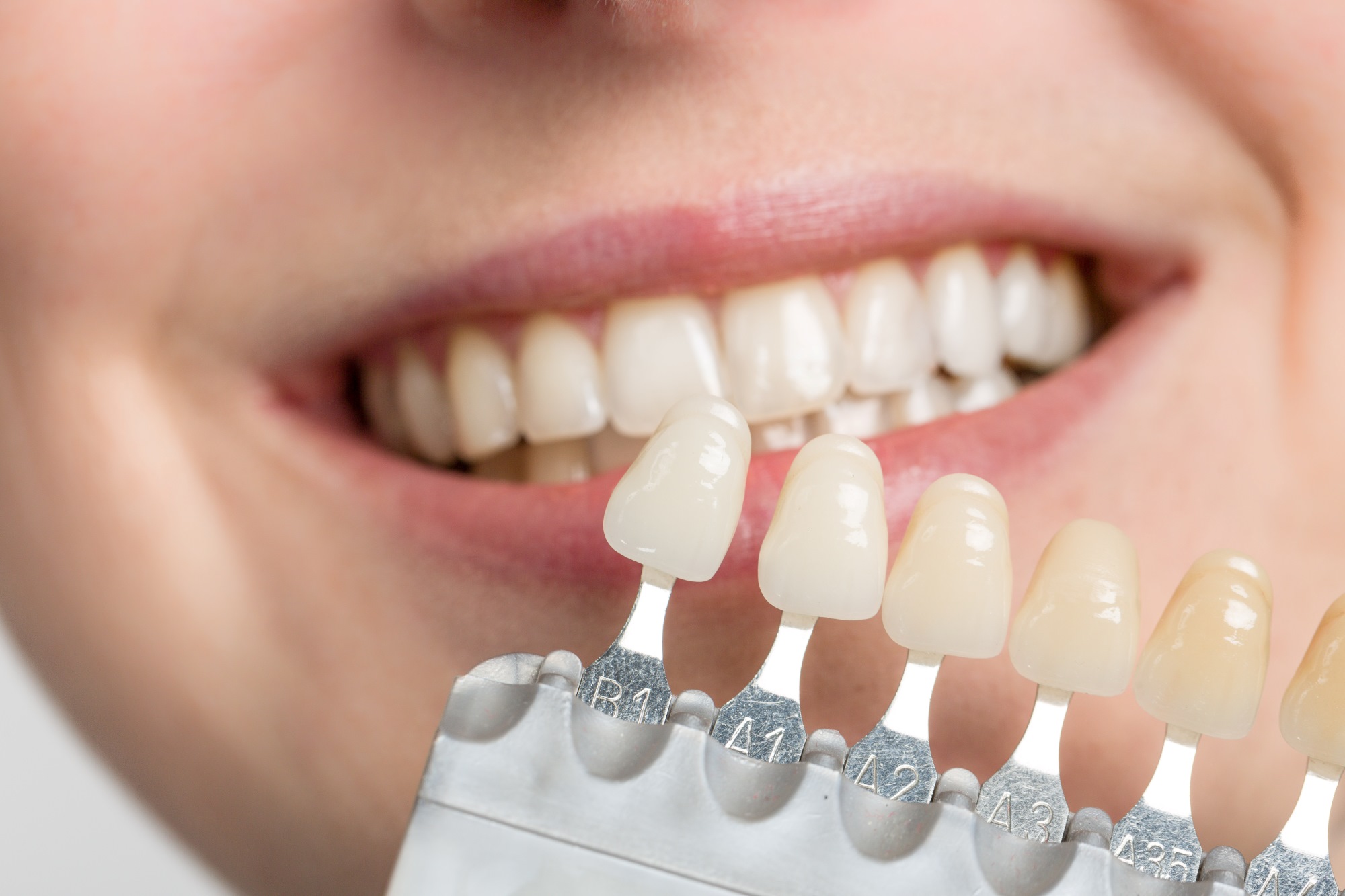 How Long Does It Take To Have Dental Veneers?