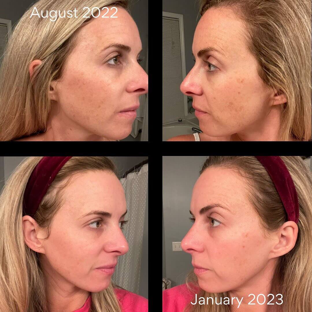 Red Light Face Mask: Rejuvenate Your Skin With HigherDOSE